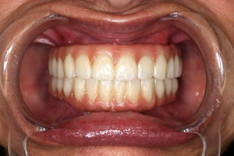 full-arch-denture